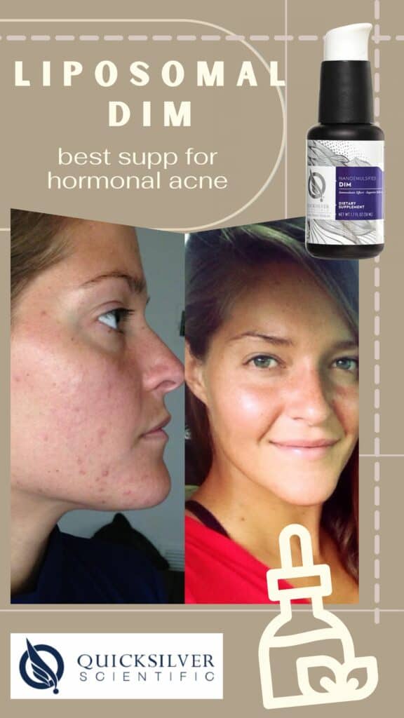 How to Cure Hormonal Acne